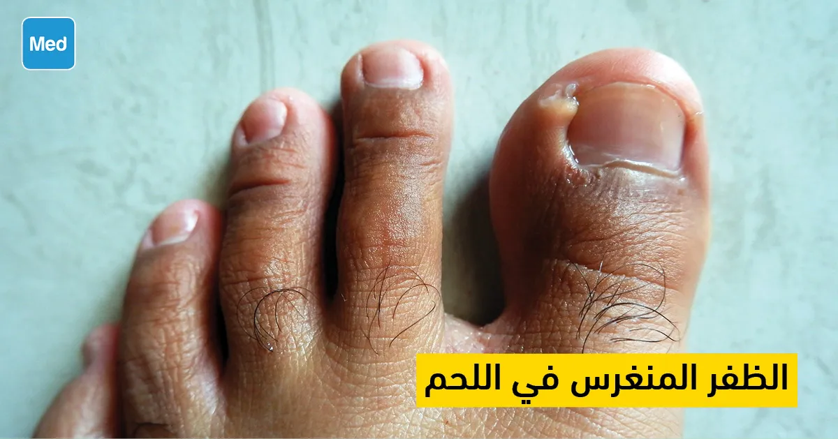 الظفر المنغرس في اللحم